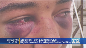 Stockton Teen Launches Civil Rights Lawsuit For Alleged Police Beating – CBS Sacramento